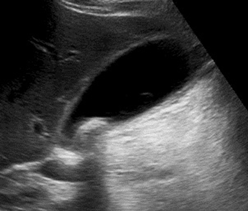 Fig. 95.1, Calculous cholecystitis. Ultrasound of the gallbladder demonstrating a shadowing calculus at the gallbladder neck with gallbladder-wall thickening and sonographic tenderness.