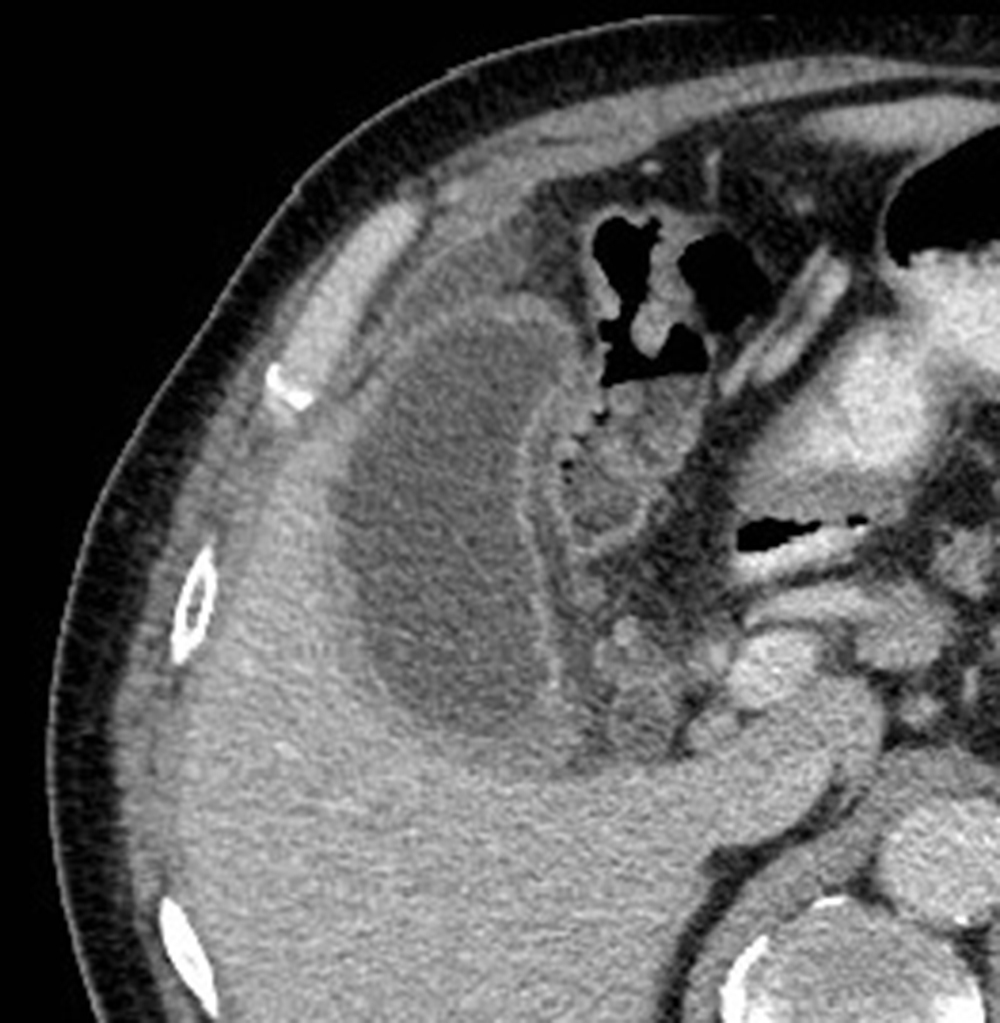 Fig. 95.2, Cholecystitis. Contrast-enhanced axial computed tomography image demonstrating gallbladder distension, stranding of the pericholecystic fat, and pericholecystic fluid.