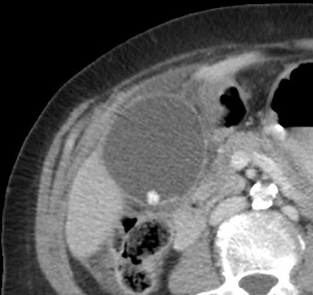 Fig. 95.3, Calculous cholecystitis. Contrast-enhanced axial computed tomography image demonstrating a dependent calcified stone within the gallbladder with gallbladder distension and pericholecystic fluid.