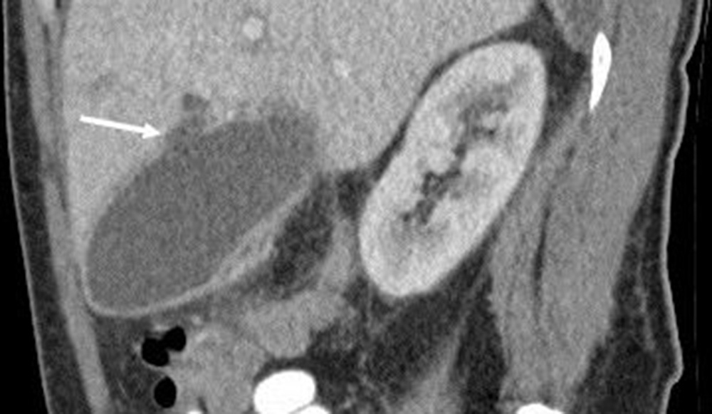 Fig. 95.4, Cholecystitis with gallbladder-wall perforation. Sagittal contrast-enhanced image demonstrating a small perforation of the gallbladder wall ( white arrow ) with a small adjacent pericholecystic abscess in a patient with acute cholecystitis.