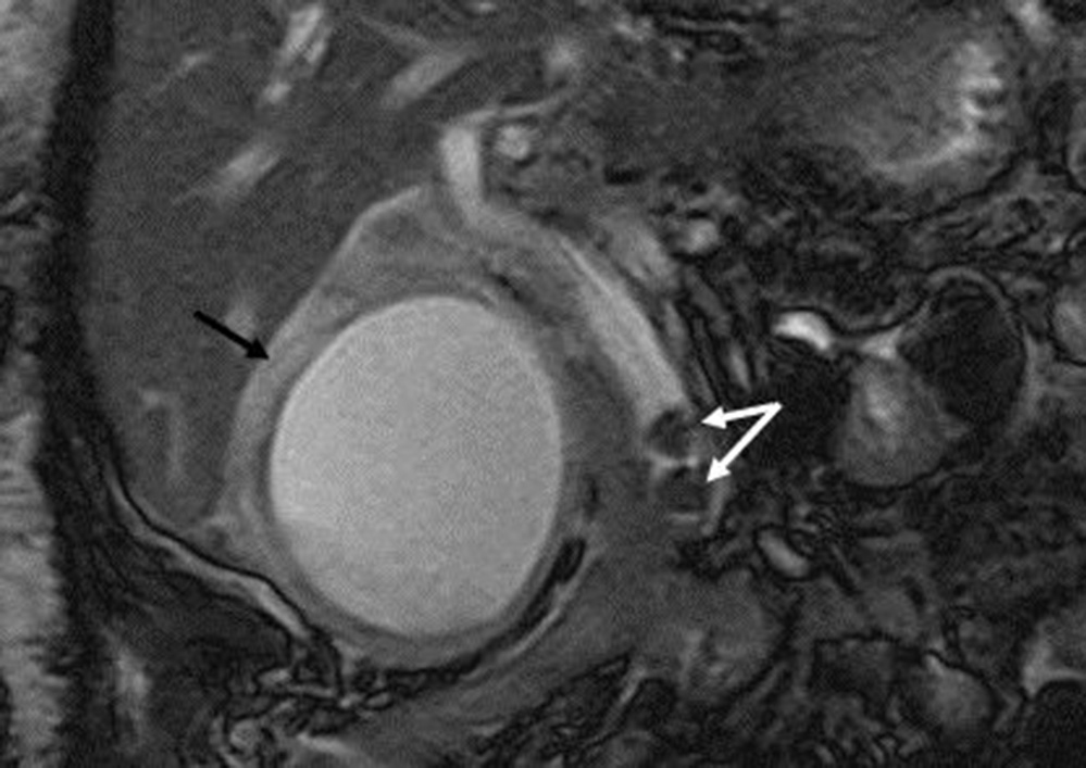 Fig. 95.5, Calculous cholecystitis. Coronal T2-weighted magnetic resonance image demonstrating a distended gallbladder with pericholecystic fluid ( black arrow ) and choledocholithiasis ( white arrows ) and common bile duct dilatation.