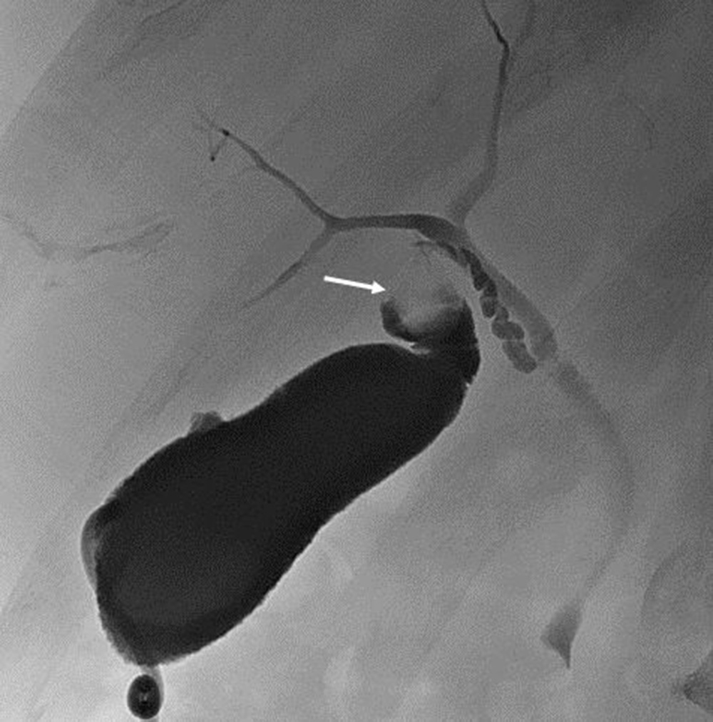 Fig. 95.6, Impacted stone at the gallbladder neck. Cholangiogram via a cholecystostomy catheter demonstrating an impacted stone at the neck of the gallbladder ( white arrow ) in a patient with acute cholecystitis.