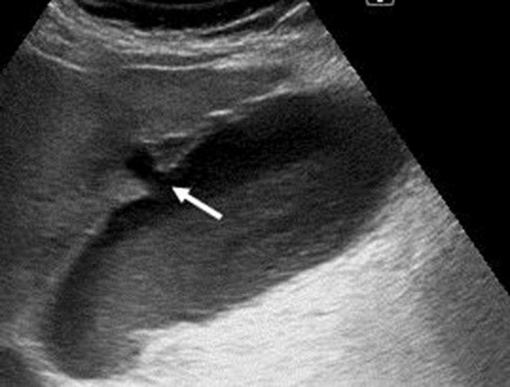 Fig. 95.7, Cholecystitis with gallbladder wall perforation. Ultrasound image demonstrating a localized perforation of the gallbladder wall ( white arrow ) in a patient with acute cholecystitis. Ultrasound also demonstrates gallbladder distension and echogenic sludge.