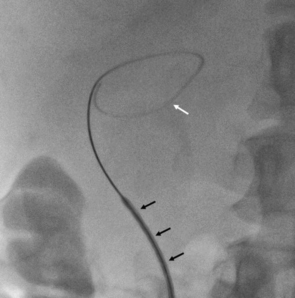 Fig. 95.9, Cholecystostomy tube insertion. Short Amplatz Super Stiff wire looped within the gallbladder ( white arrow ) supporting drainage catheter insertion ( black arrows ).