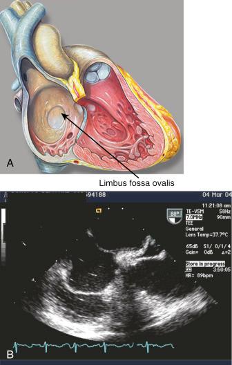 Fig. 49.1, Diagram (A) and sonogram (B) of the interatrial septum depict the limbus of the fossa ovalis and the anatomic location of the patent foramen ovale.