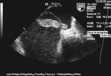 Fig. 49.2, The thrombus in transit from the right atrium through a patent foramen ovale into the left atrium illustrates the concept of paradoxical embolization.