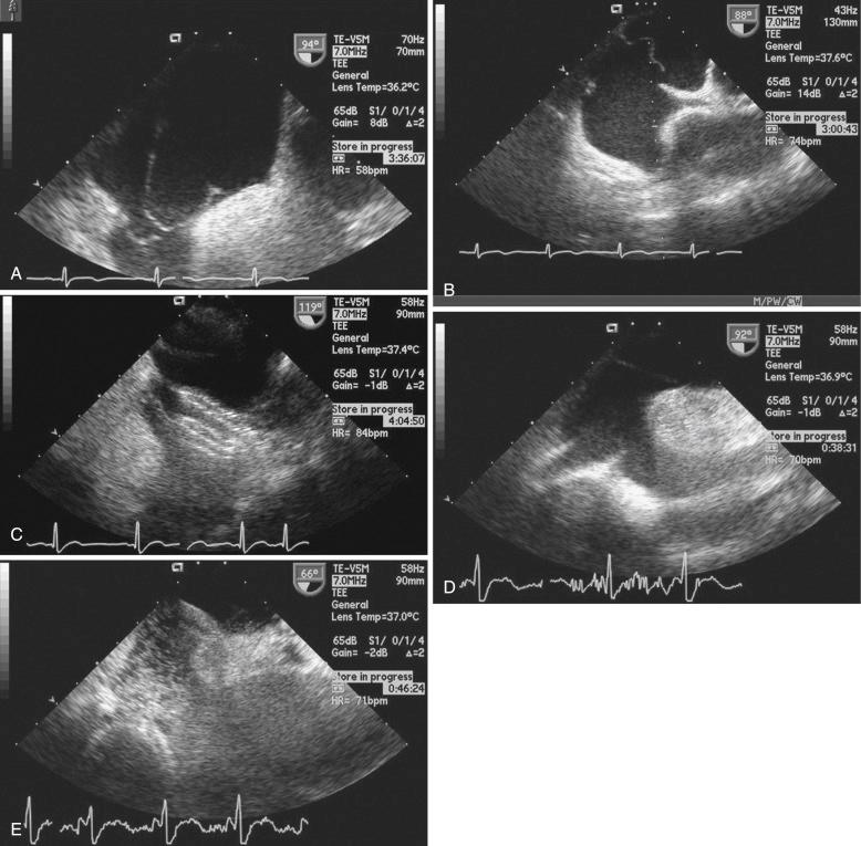 Fig. 49.3, Transesophageal echocardiogram in the bicaval view (90 degrees) identifies right atrial cardiac structures that may increase the degree of right-to-left shunt across a patent foramen ovale (PFO) or may complicate the closure procedure. (A) Prominent eustachian valve. (B) Atrial septal aneurysm. (C) A 25-mm AGA foramen occluder (AGA Medical, Plymouth, MN) successfully captures the septum secundum and primum closing the PFO. (D and E) Lipomatous hypertrophy of the atrial septum also creates a challenge in placing the closure device. Immediately after device deployment, the saline contrast study is mildly positive.