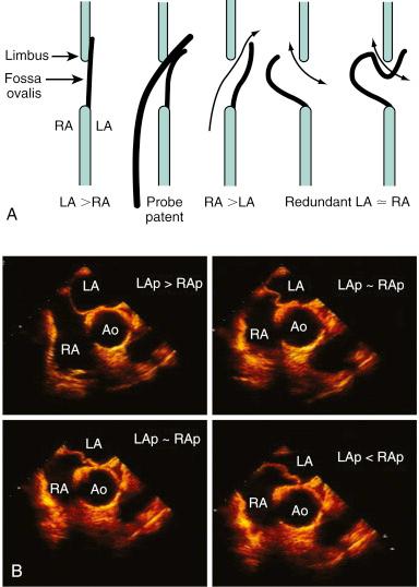 Fig. 49.7, (A) Association of interatrial septal anatomy and direction of interatrial shunt. (B) Transesophageal echocardiograms depict interatrial septal mobility related to left and right atrial pressures. Ao , Aorta; LA , left atrium; LAp , left atrial pressure; RA , right atrium; RAp , right atrial pressure.