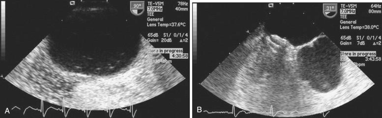Fig. 49.8, Transesophageal echocardiogram before (A) and after (B) placement of a 25-mm AGA foramen occluder (AGA Medical, Plymouth, MN). Saline contrast is present in the left atrium before device placement. After device placement, the saline contrast study is negative.