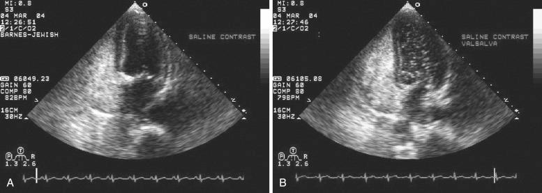 Fig. 49.9, Transthoracic echocardiogram with a saline contrast study at rest (A) and during a Valsalva maneuver (B). Transient increase in the right atrial pressure during the release phase of the Valsalva maneuver demonstrates a large right-to-left shunt at the atrial level due to a patent foramen ovale.