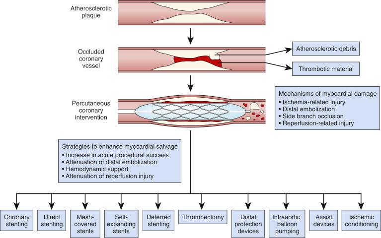 Fig. 20.11, Mechanical strategies to enhance myocardial salvage during primary percutaneous coronary intervention in patients with ST-segment elevation myocardial infarction.