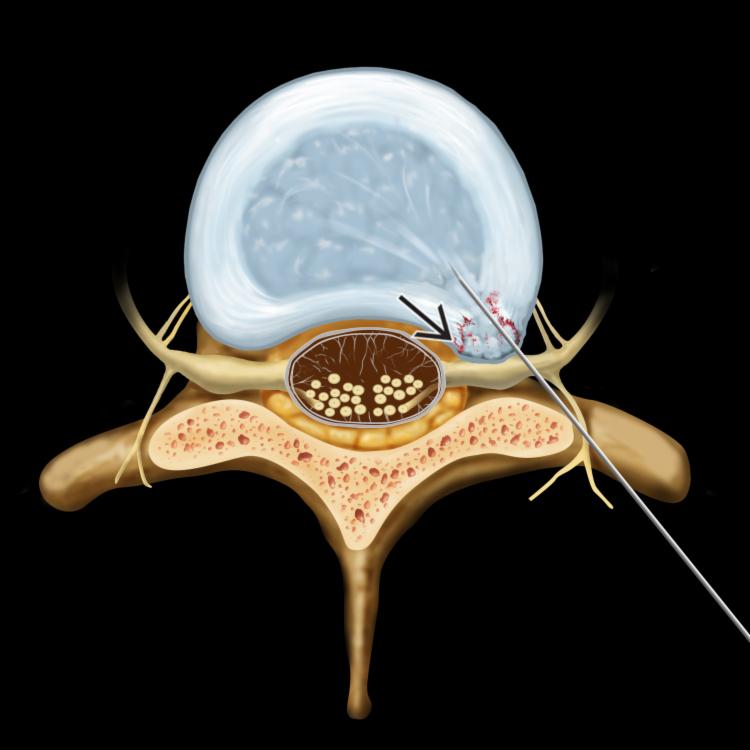 Percutaneous Discectomy Approach