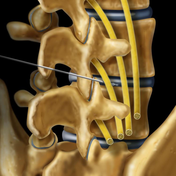 Sagittal Oblique Graphic of Percutaneous Discectomy