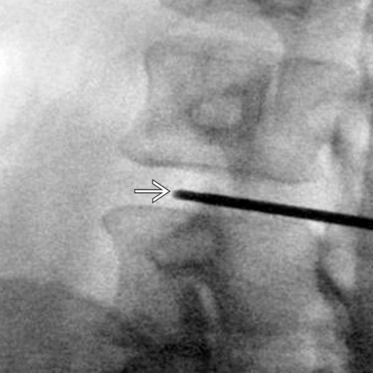 Lateral Oblique Radiograph of Percutaneous Discectomy