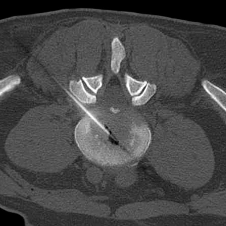 Axial CT of Percutaneous Discectomy