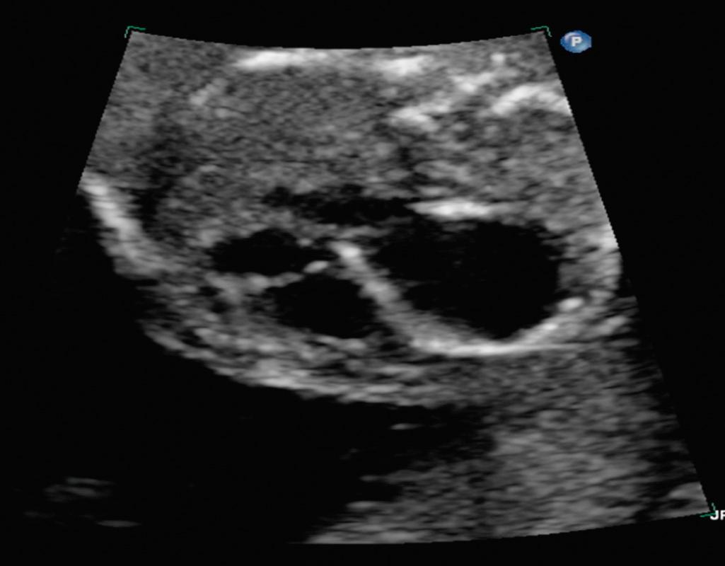 Fig. 10.1, Four-chamber view demonstrating severe left ventricular dilation as a result of aortic stenosis in a midgestation fetus.