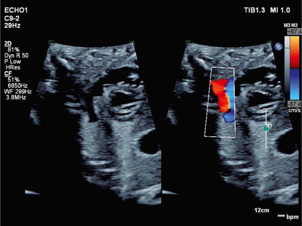 Fig. 10.2, Sagittal image depicting retrograde flow in the transverse aortic arch in a midgestation fetus with severe aortic stenosis and evolving hypoplastic left heart syndrome.