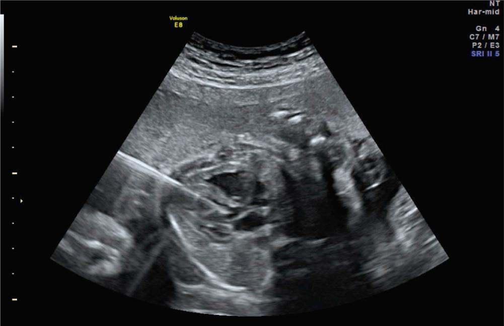 Fig. 10.5, Needle insertion into the left ventricular apex and aimed toward the left ventricular outflow tract.