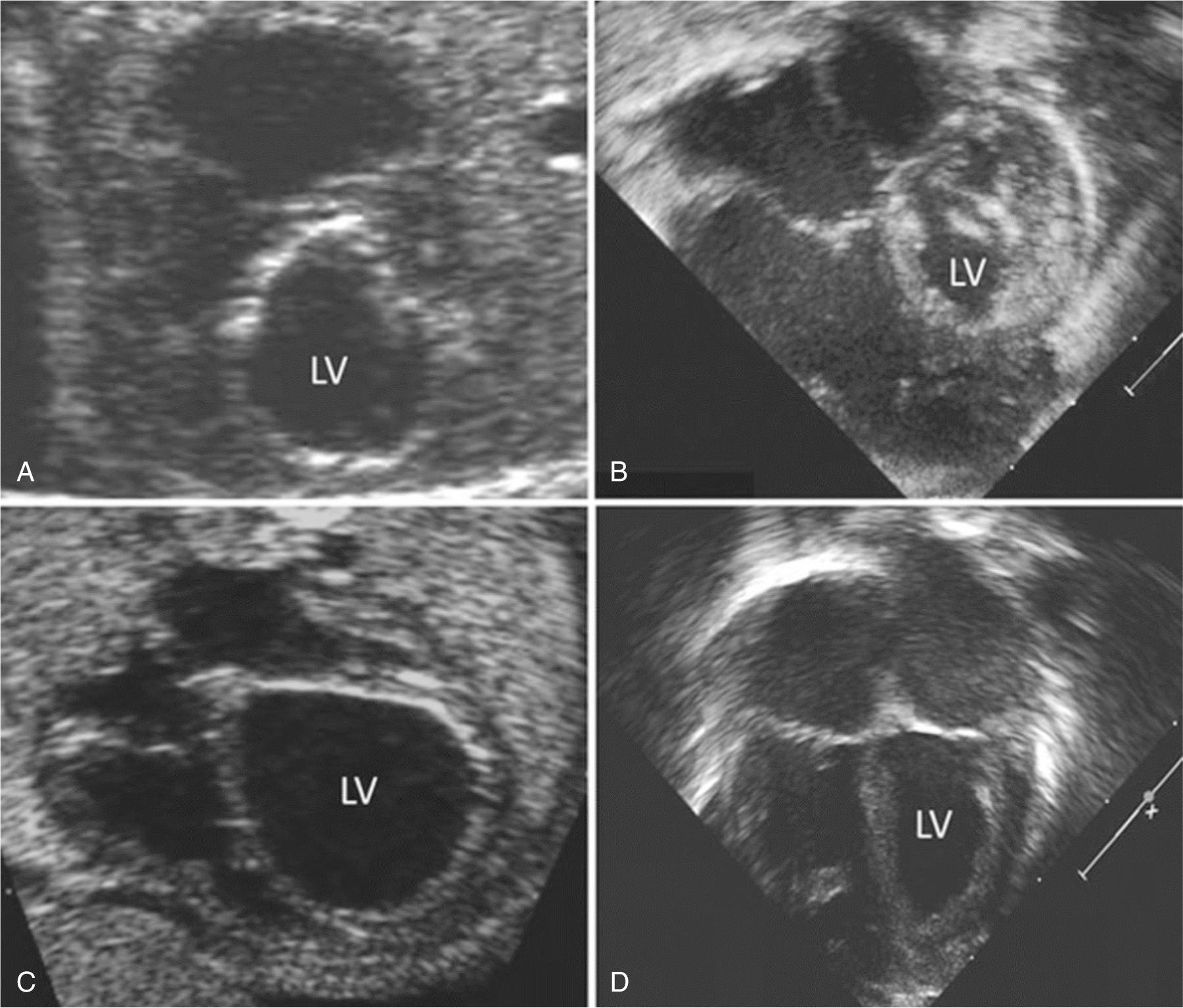 Fig. 10.6, Four-chamber views of the heart in two patients, with the preintervention fetal echocardiograms on the left and the postnatal echocardiograms on the right. (A–B) This patient had a technically unsuccessful fetal aortic valvuloplasty and was managed with staged univentricular palliation after birth. (C–D) This patient had a technically successful procedure and a biventricular outcome. LV, Left ventricle.
