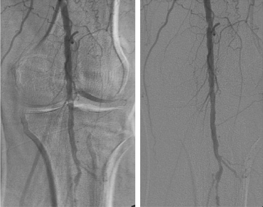 FIGURE 74-1, Digital subtraction angiogram of the popliteal artery with moderate motion of the patient confounding the popliteal evaluation and after “shifting” of the image to re-mask the underlying bone structures for direct angiographic evaluation of the anatomy.