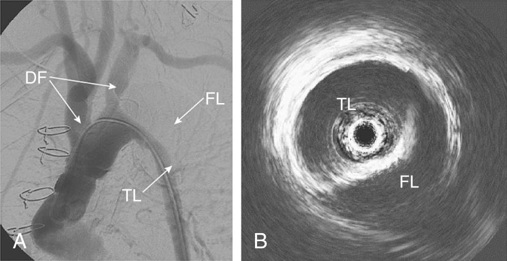 FIGURE 74-2, (A) Angiogram and (B) intravascular ultrasound image of a patient with type A dissection of the aortic arch. The false lumen (FL) and true lumen (TL) are evident in the intravascular ultrasound image. The arrows on the angiogram correlate with the site of the intravascular ultrasound image. DF, Dissection flap.