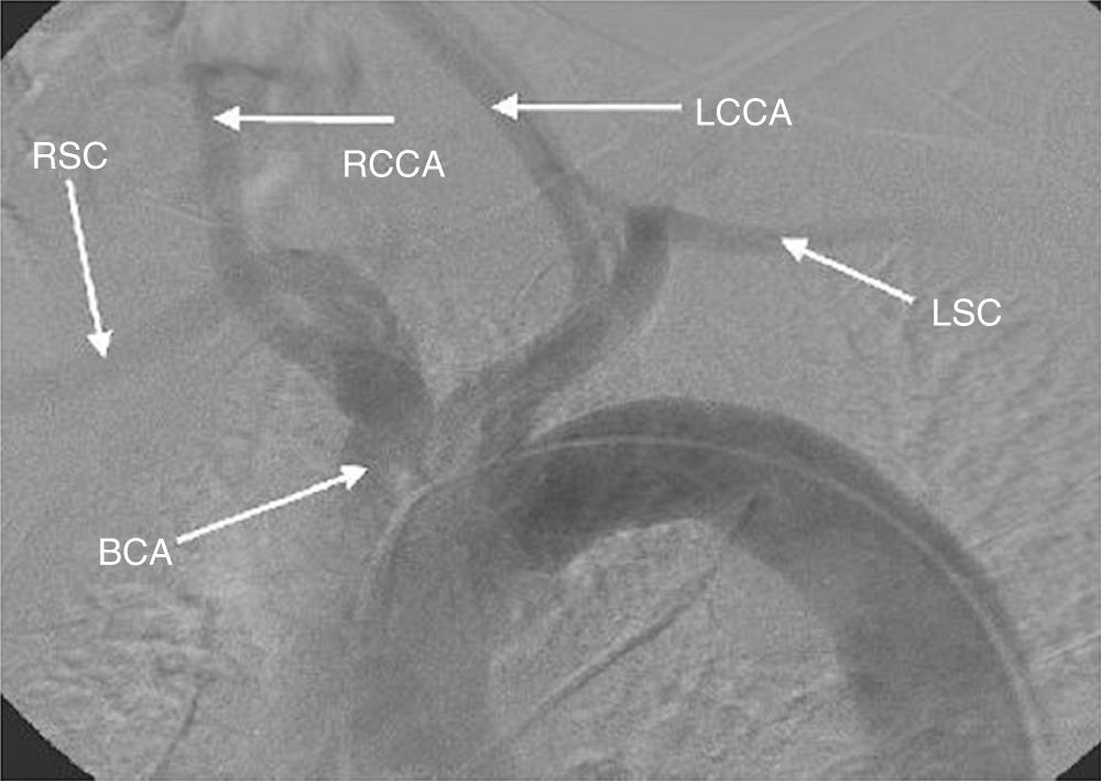 FIGURE 74-3, Digital subtraction angiography of the thoracic arch and great vessels. BCA, Brachiocephalic artery; LCCA, left common carotid artery; LSC, left subclavian artery; RCCA, right common carotid artery; RSC, right subclavian artery.