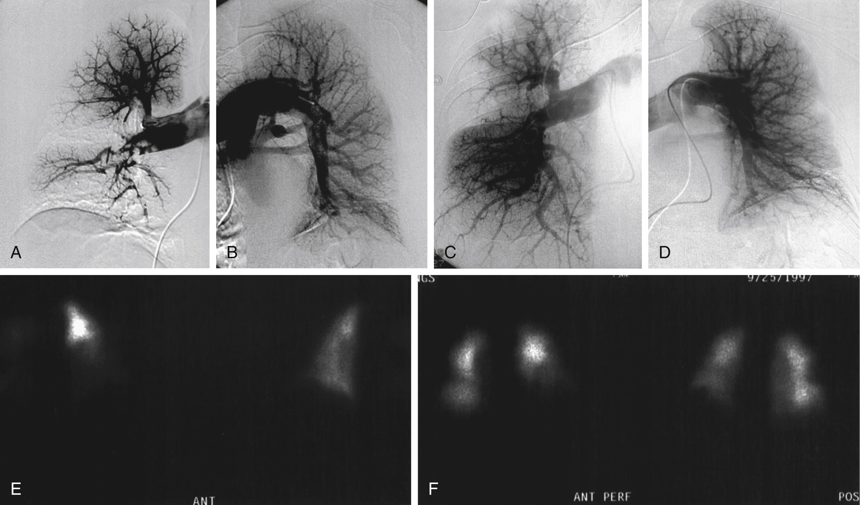 Fig. 55.3, A patient with massive PE presented with syncope. (A) A right pulmonary angiogram showed a large central embolism with thrombus occluding most of the artery and sparing just a portion of the right upper lobe. (B) Left pulmonary angiography showed large filling defects in the main left pulmonary artery. Catheter-directed therapy was initiated first to debulk the central emboli. Bilateral infusion catheters were then placed into the main thrombus in the right and left pulmonary arteries, and urokinase was initiated at 50,000 IU/h through each catheter for a total infusion of 100,000 IU/h for a total of 24 hours. (C) and (D) Posttreatment angiography showed significant improvement of the bilateral pulmonary circulation. The patient experienced dramatic clinical improvement, along with a reduction of pulmonary artery pressures and improvement between the preperfusion (E) and postperfusion (F) scans.