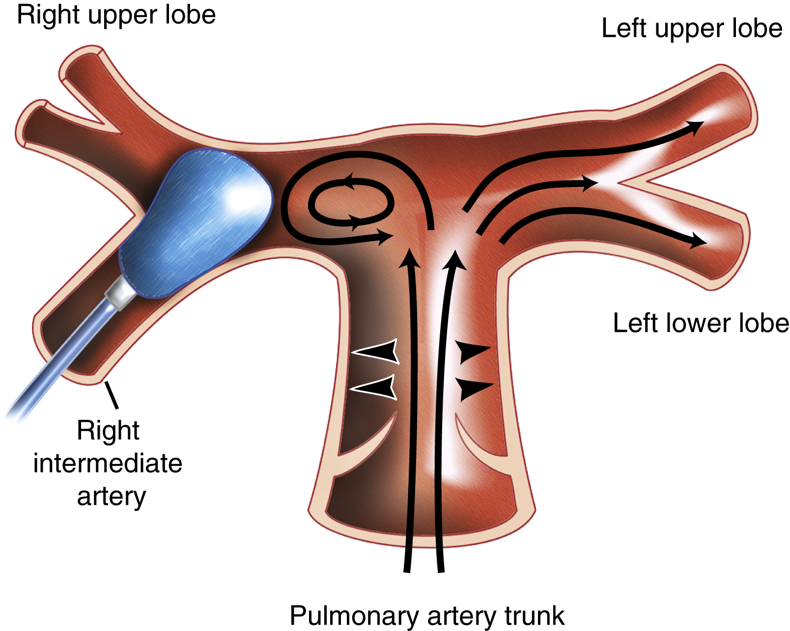 Fig. 55.4, Schematic drawing of a pulmonary arterial flow model showing vortex formation immediately proximal to the level of obstruction. Note the prominent vortex near the occlusion causing most of the circulating fluid to flow toward the nonoccluded left pulmonary artery. There is minimal fluid contact with the occluding embolus (the balloon).