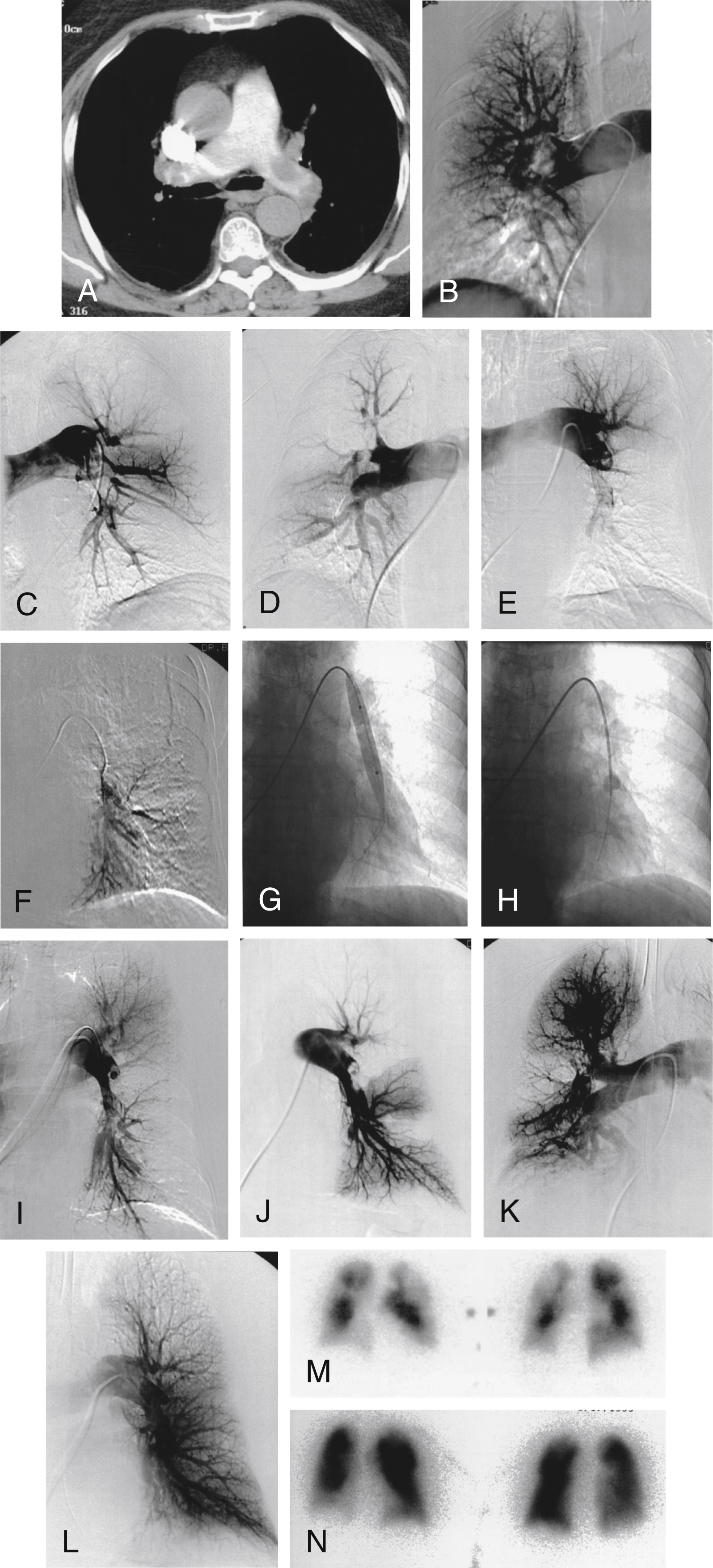 Fig. 55.5, A 78-year-old man presented to the emergency department with symptoms of chest pain and shortness of breath. A chest computed tomographic (CT) arteriogram was positive for acute pulmonary embolism. The Interventional Radiology department was consulted for possible catheter-directed treatment. (A) CT scan of the chest showed large filling defects in both main pulmonary arteries. The patient was taken to the angiography suite. (B) Right pulmonary angiography showed severe obstruction of the bifurcation of the right main pulmonary artery. There was reduced perfusion of the right upper lobe and marked hypoperfusion of the right lower lobe. (C) Left pulmonary angiography showed a large embolism involving the left lower lobe with marked reduction in peripheral perfusion. The pulmonary artery pressure was 50 mm Hg. (D) A follow-up right pulmonary angiogram after 24 hours of catheter-directed thrombolytic infusion showed marked improvement in the obstruction with residual thrombus involving the right upper and middle lobes. There was interval improvement in right lower lobe perfusion. (E) Follow-up left pulmonary angiography showed progressive occlusion of the left lower lobe, likely from distal migration of a proximal thrombus. The pulmonary artery pressure was 40 mm Hg. (F) Selective catheterization of the lower lobe branch, through the clot, was performed and showed total occlusion of the lower lobe artery (G) A 10-mm balloon catheter was used to break down the clot over a wire advanced into the lower lobe branches. (H) An occlusion balloon catheter was trawled back several times to thrombectomize the clots. (I) Angiography after mechanical balloon thrombectomy showed improved patency of the lower-lobe segment. A catheter was placed within the partially occluded artery and thrombolytic infusion was continued. (J) Follow-up angiogram of the left pulmonary artery treatment showed significant improvement in the left lung perfusion. Infusion at the same rate was performed for additional 15 hours. (K) After 36 hours of local thrombolytic infusion, a final right pulmonary angiogram showed significant improvement in right pulmonary perfusion. (L) The final left pulmonary angiogram showed near-complete patency of the left pulmonary artery and the peripheral branches. The mean pulmonary artery pressure after treatment was 33 mm Hg, and the patient was weaned off the ventilator and extubated. (M) Pretreatment perfusion scan showed a high probability picture with multiple extensive areas of hypoperfusion. (N) Perfusion scan 3 days after thrombolytic treatment showed remarkable improvement in bilateral pulmonary perfusion