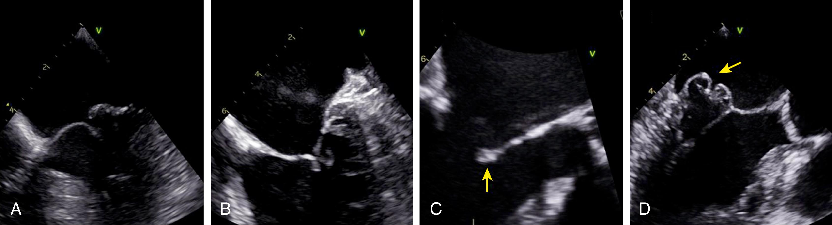 Figure 166.1, Morphologic criteria for the MitraClip device using two-dimensional transesophageal echocardiography. A, Optimal: isolated P2 flail with a flail gap smaller than 10 mm. B, Optimal: reduced coaptation with adequate coaptation length and depth. C, Unsuitable: anterior leaflet calcification at the grasping zone (arrow) . D, Unsuitable: multiple segments with severe billowing (arrow) . (See accompanying Video 166.1 .)