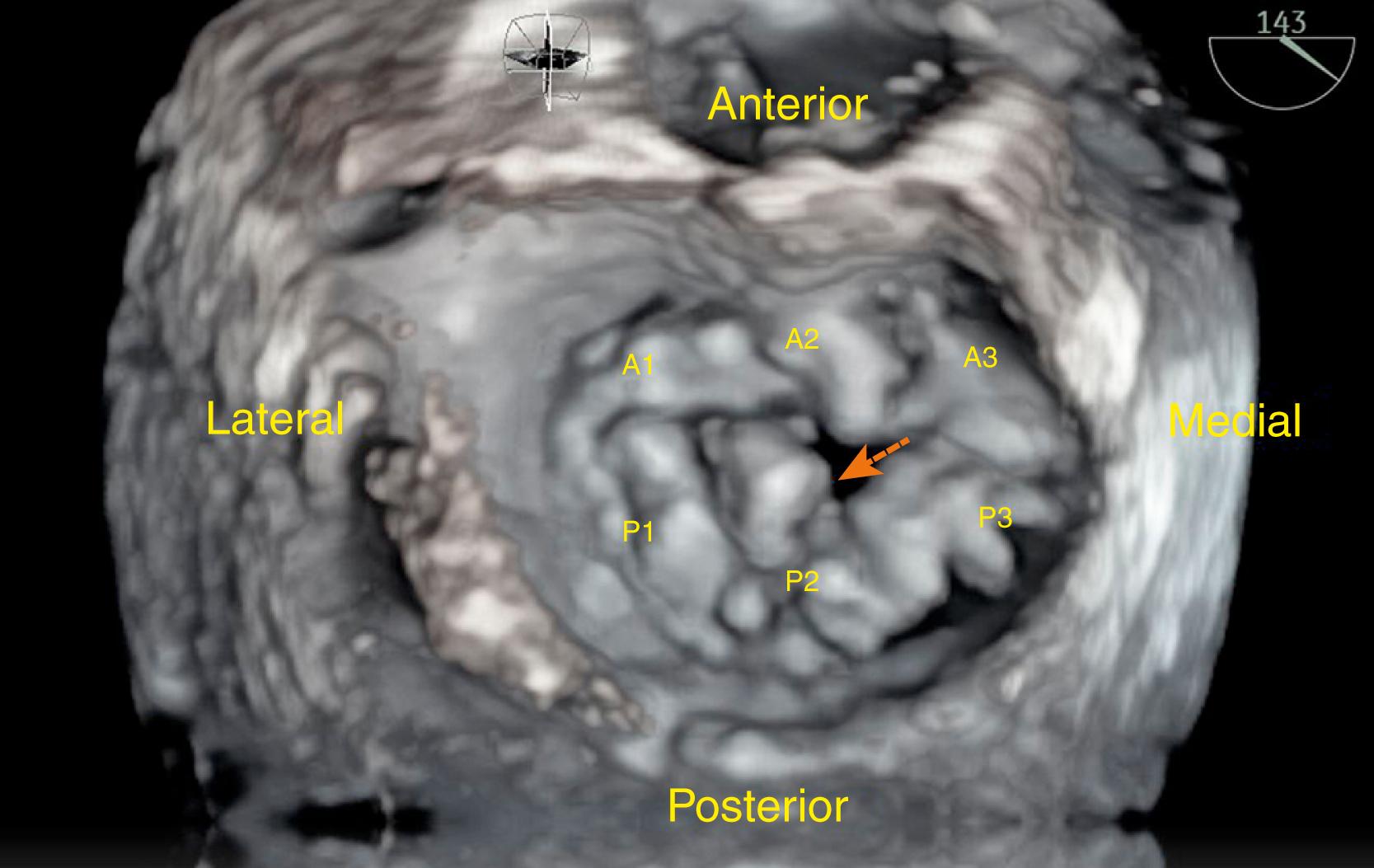 Figure 166.2, Three-dimensional transesophageal echocardiography mitral valve en face (“surgeon’s view”) from the left atrium, with appropriate anatomic landmarks. This patient has severe prolapse and flail of the P2 scallop (arrow) . (See accompanying Video 166.2 .)