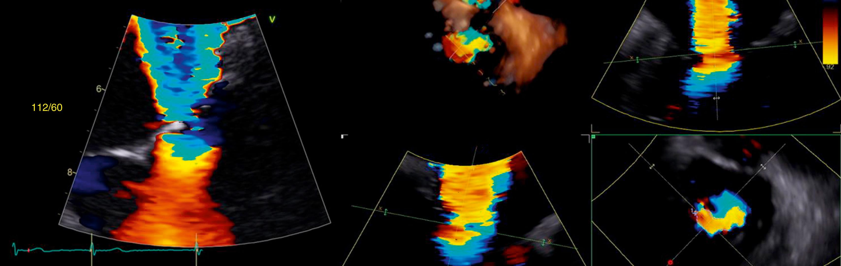 Figure 166.3, Two- and three-dimensional transesophageal views of mitral regurgitation (MR) used for quantitation of MR severity. Note in the three-dimensional reconstruction that the MR effective orifice area is not a circle, but rather ovaloid, along the coaptation line of the valve.