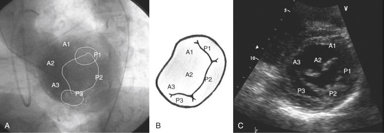 Fig. 52.1, Mitral valve anatomy.