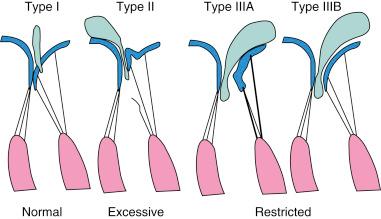 Fig. 52.2, Carpentier classification of mitral regurgitation according to function leaflet mobility.