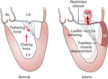 Fig. 52.3, Left panel , Balance of forces acting on mitral leaflets in systole. Right panel , Infarction causes LV cavity dilatation and papillary muscle displacement, which together result in annular dilatation, leaflet tethering, and restricted leaflet motion. Both factors contribute to functional mitral regurgitation (MR) . Dark shading indicates inferobasal myocardial infarction (MI) ; light shading indicates normal baseline. Ao , Aorta; LA , left atrium; LV , left ventricle.