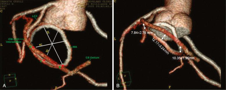 Fig. 52.4, Computed tomographic images of the relationships among the mitral annulus (MA) , the coronary sinus (CS) , and the left circumflex (LCX) coronary artery. (A) The CS travels along the posterior MA and crosses over the LCX artery. (B) The distance between the MA and the CS varies depending on the location along the annulus.