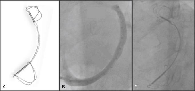 Fig. 52.6, Carillon indirect mitral annuloplasty system.