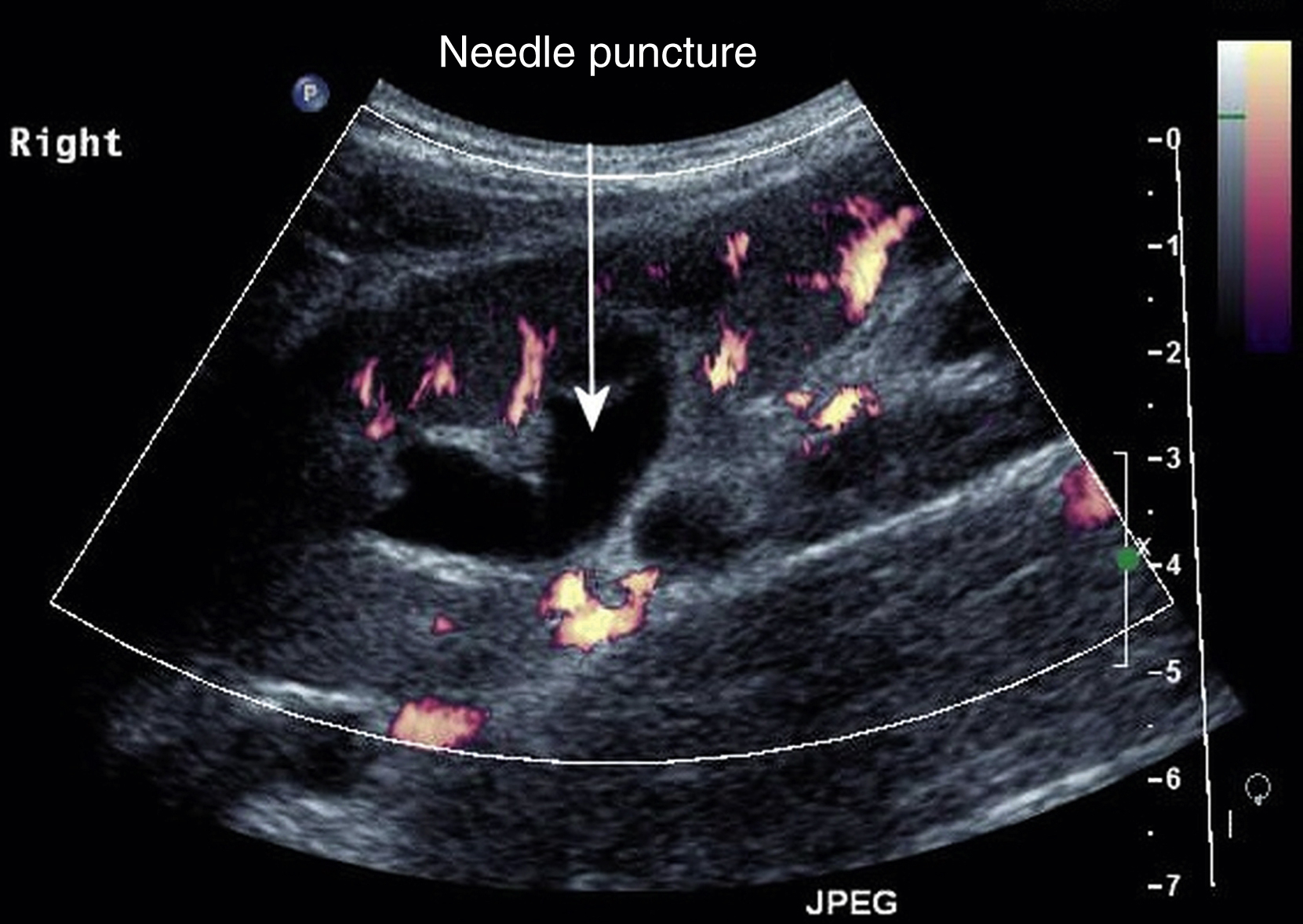 Fig. 100.1, This image shows a good calyx and angle for puncture in the relatively avascular plane of Brodel.