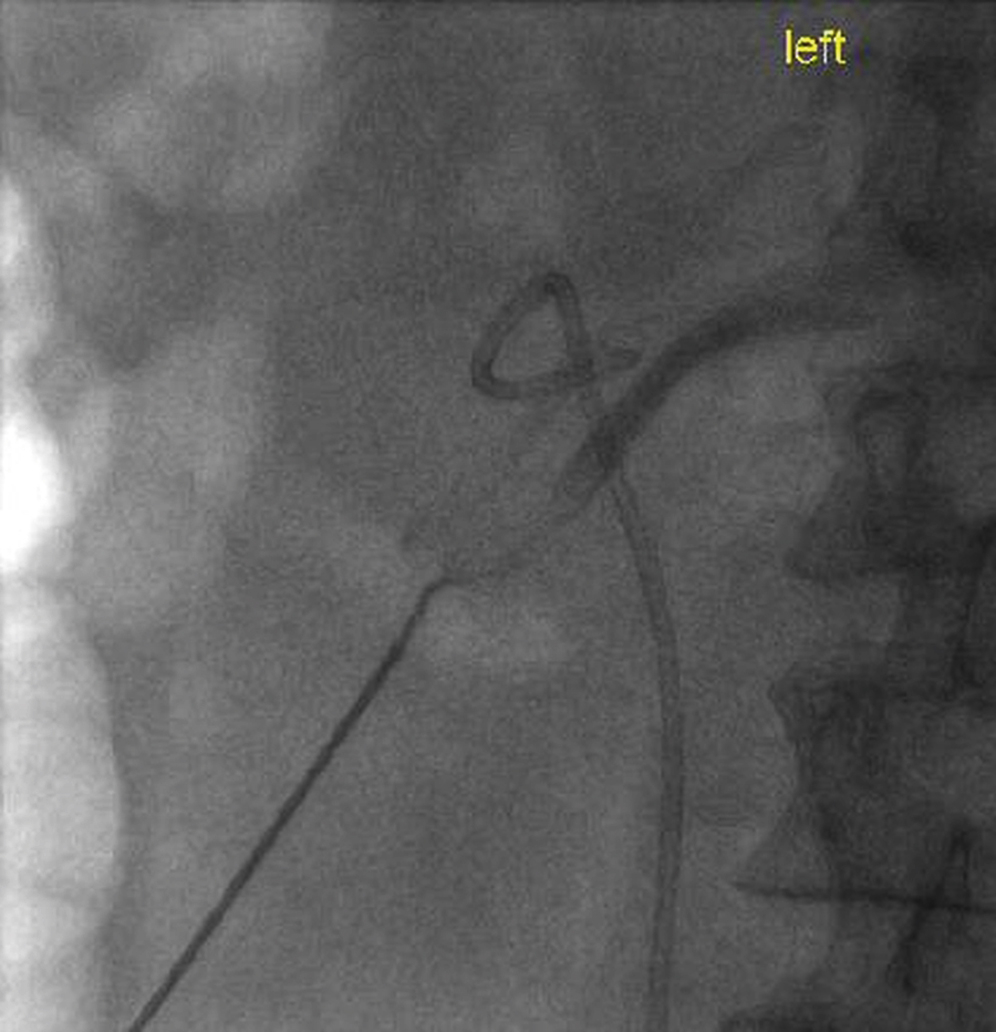 Fig. 100.11, Contrast seen to flow freely into a branch of the left renal vein while attempting to access a nondilated collecting system.