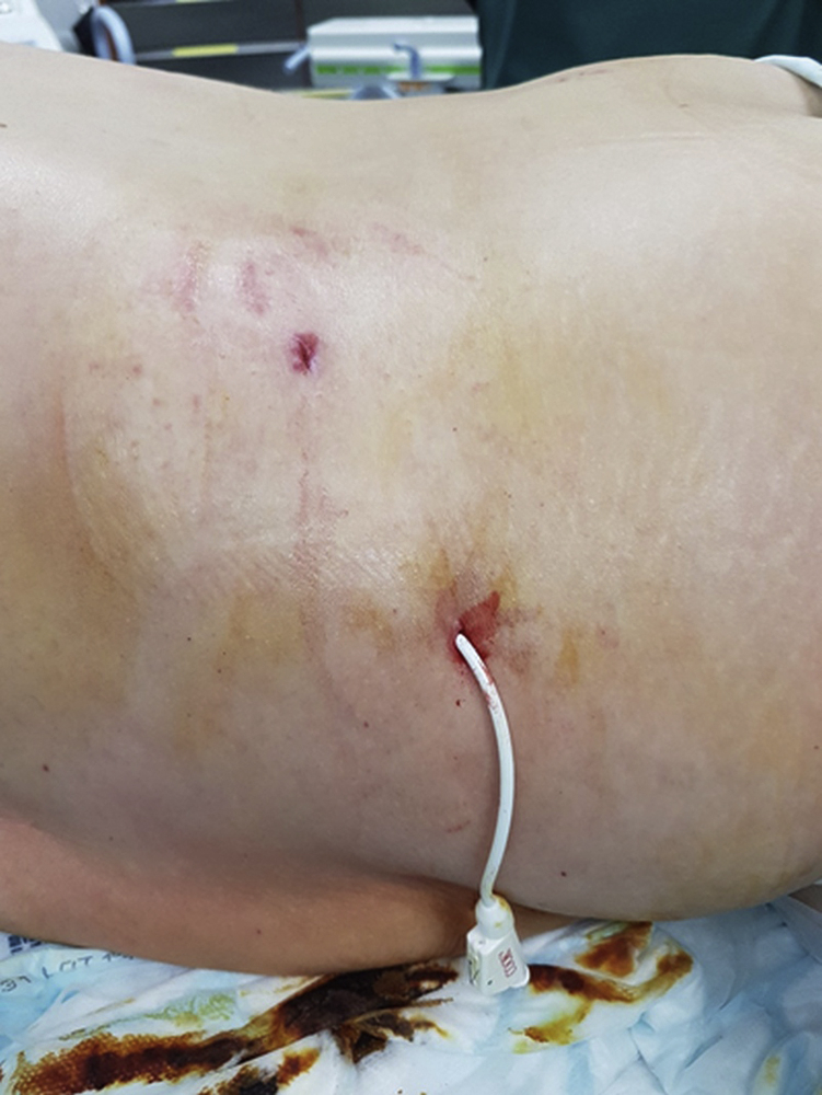 Fig. 100.2, This left-sided percutaneous nephrostomy (PCN) was repositioned more laterally after a few weeks at the patient’s request when it became apparent that they were going to need to manage the PCN themselves.