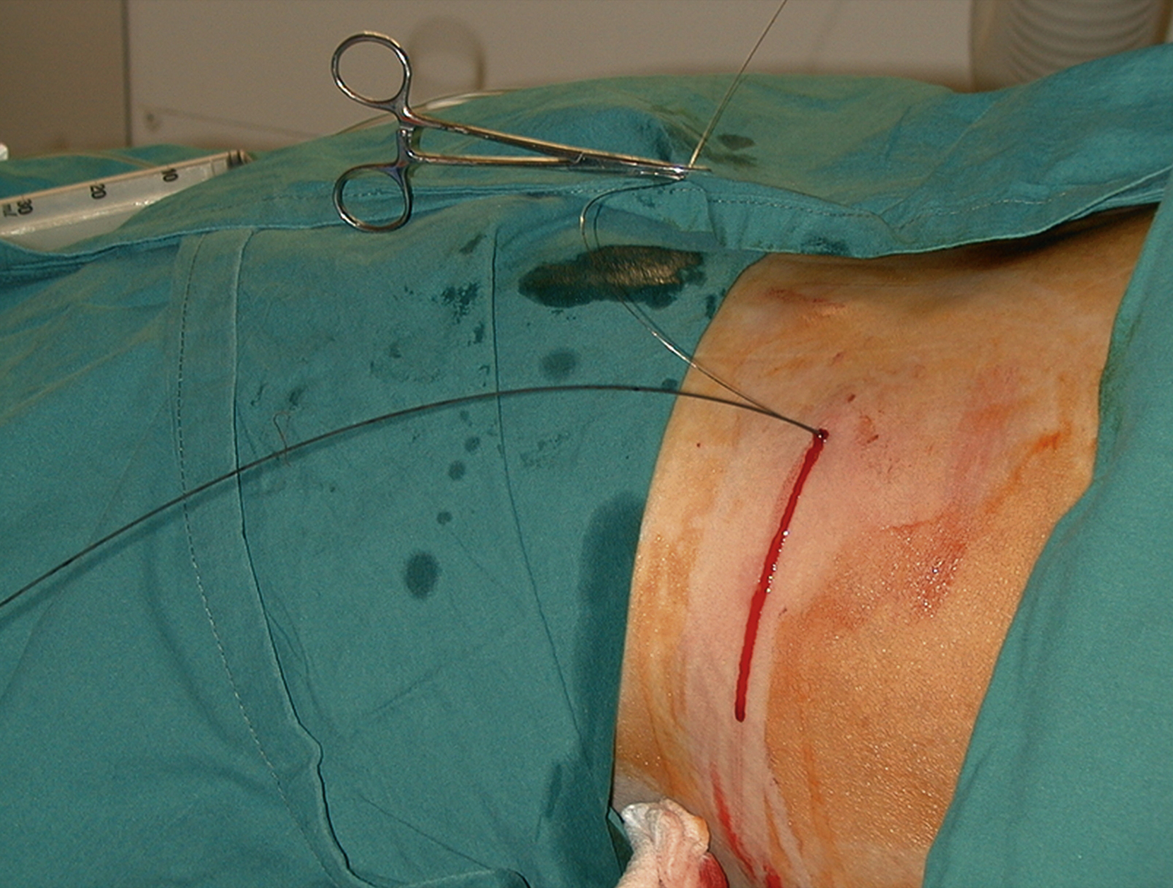 Fig. 100.6, The outer sheath has been removed over the 0.018-inch and 0.035-inch wires, with the 0.018-inch wire clipped to one side as a safety wire that can be removed once the percutaneous nephrostomy has been inserted.