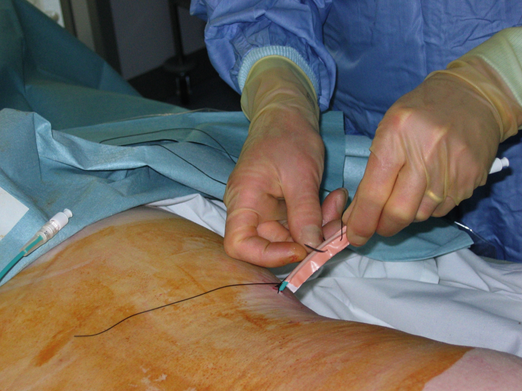 Fig. 100.7, Stitching a 7F percutaneous nephrostomy into place with a “flag” of adhesive tape on the catheter to allow suturing.