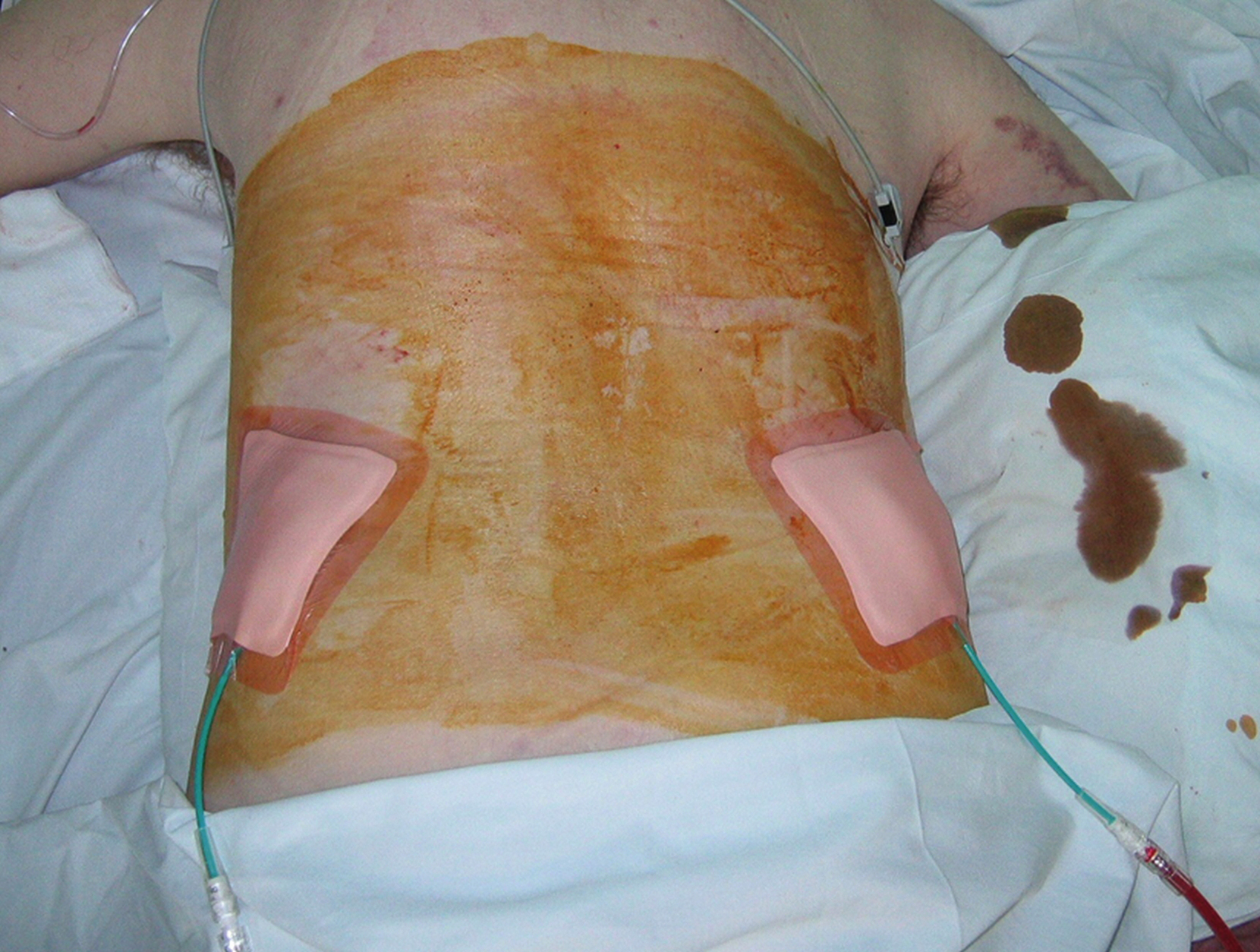 Fig. 100.10, Bilateral nephrostomy tubes connected to drainage bags in a patient in intensive care.