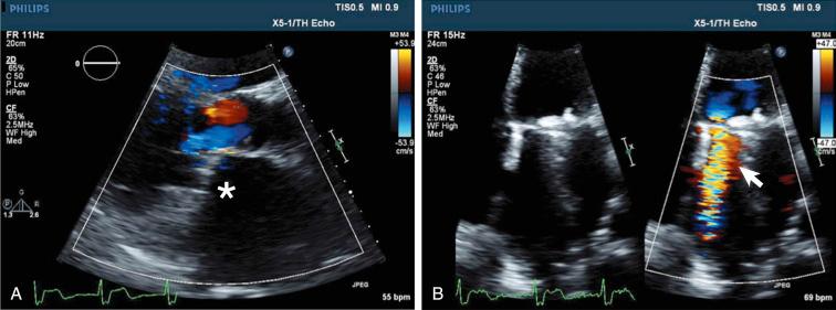 Fig. 62.1, Parasternal view (A) of the mitral valve prosthesis. The paravalvular leak is not visible in this view (∗) . In the four-chamber view (B) the medial paravalvular leak becomes visible (arrow) . Even here, however, fine manipulations of the ultrasound probe were necessary to find the best color Doppler signal.
