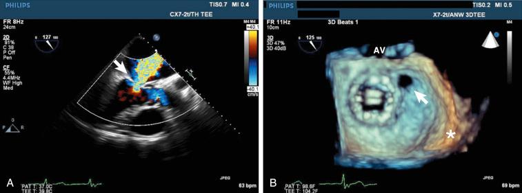 Fig. 62.2, Two-dimensional images (A) and 3D images (B) of the paravalvular leak (arrow) , which reveal an anteromedial location of the paravalvular leak (the interatrial septum (∗) as well as the aortic valve [AV] serve as anatomical markers for orientation purposes). The orifice of the paravalvular leak measured 7 to 8 mm in diameter.