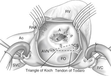 Fig. 57.1, Surgical perspective of the tricuspid valve complex.