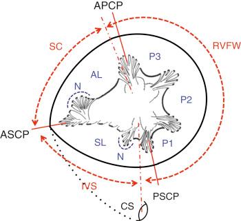 Fig. 57.2, Schematic diagram of the surgeon’s view of the tricuspid valve.