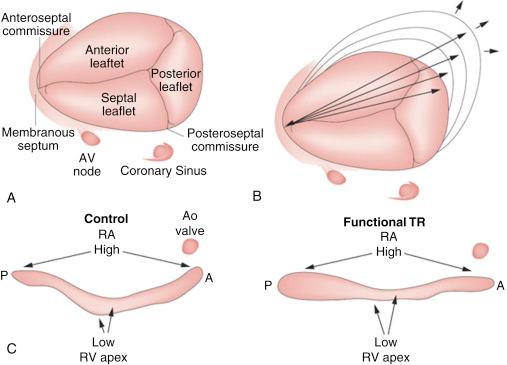 Fig. 57.3, Anatomy of the tricuspid valve (A) and normal tricuspid annulus (C, left image ) with a nonplanar morphology; the highest points are in the anteroposterior direction and the lowest in the mediolateral direction. In patients with functional tricuspid regurgitation, the annulus becomes more planar (C, right image ) and dilated in the anteroposterior diameter (B). A, Anterior; Ao , aorta; AV, aortic valve; P, posterior; RA , right atrium; RV , right ventricle; TR , tricuspid regurgitation.