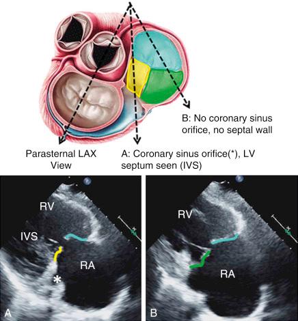 Fig. 57.4, Transesophageal echocardiographic parasternal inflow views.