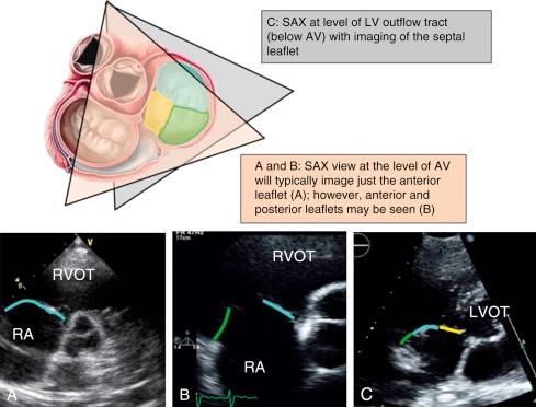 Fig. 57.5, Transesophageal echocardiographic parasternal short-axis (SAX) views.